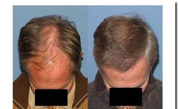 Hair restoration procedure results