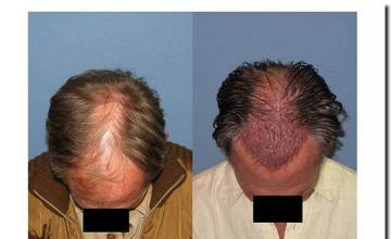 Hair restoration procedure results