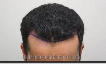 Hair restoration procedure results