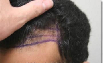 Hair restoration procedure results