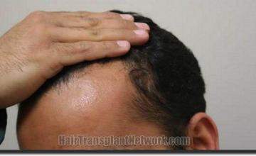 Hair restoration procedure results