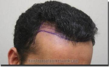 Hair restoration procedure results