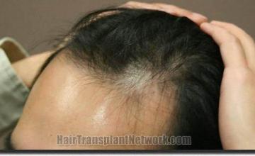 Hair restoration procedure results