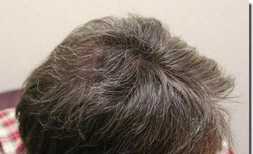 Hair restoration procedure results