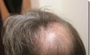 Hair restoration procedure results