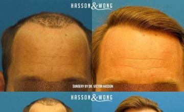 Hair restoration procedure before and after results