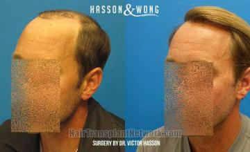 Hair transplantation surgery before and after pictures