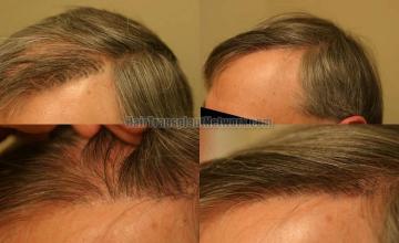 Hair restoration procedure before and after results