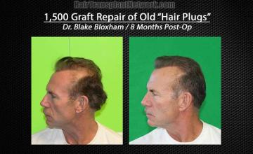 Hair restoration surgery before and after photos