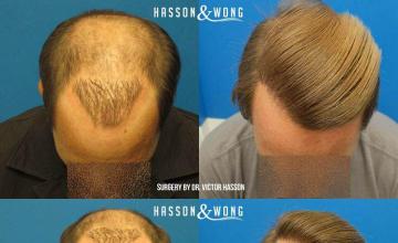 Hair restoration procedure before and after results