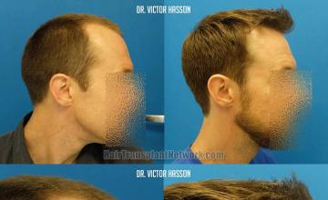 Hair restoration procedure before and after results