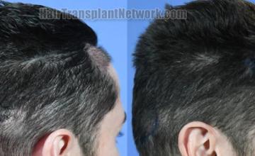 Hair transplantation surgery before and after images