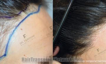 Hair transplantation surgery before and after images