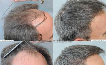 Hair transplantation surgery before and after photos