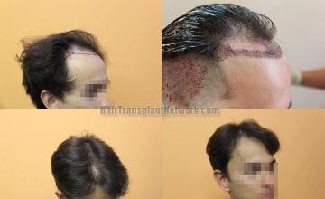 Hair transplantation surgery before and after images