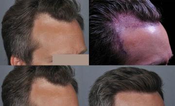 Hair restoration procedure before and after pictures