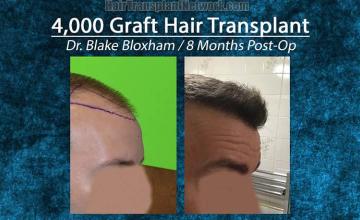 Hair transplantation procedure before and after results