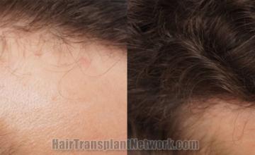 Hair transplantation surgery before and after images