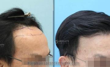 Hair transplantation procedure before and after results