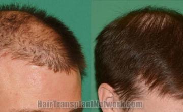 Hair restoration procedure before and after pictures