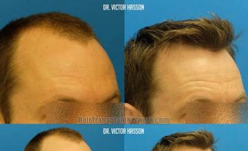 Hair restoration surgery before and after photos