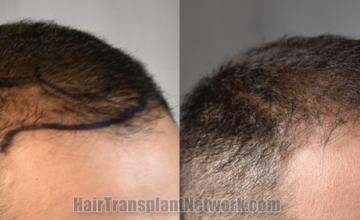 Hair transplantation surgery before and after images