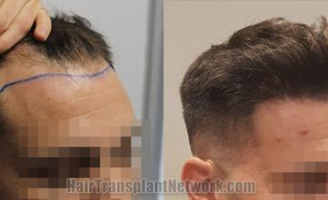 Hair transplantation surgery before and after images