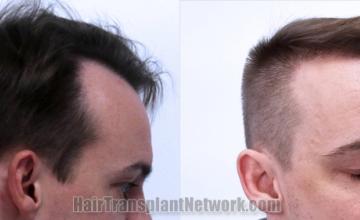 Hair transplantation surgery before and after images