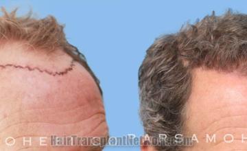 Hair transplantation surgery before and after images