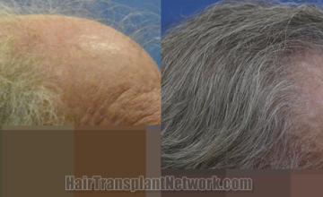 Hair transplantation surgery before and after images