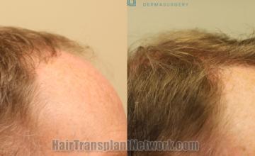 Hair transplantation surgery before and after images