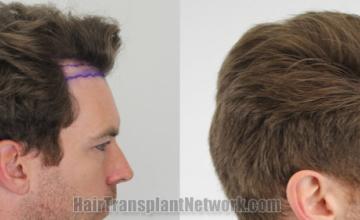 Hair transplantation surgery before and after images