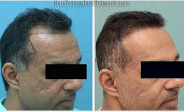 Hair transplantation surgery before and after images