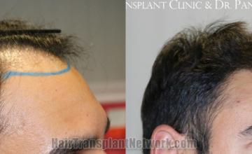 Hair transplantation surgery before and after images