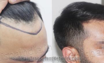 Hair transplantation surgery before and after images