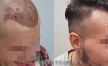 Hair transplantation surgery before and after images