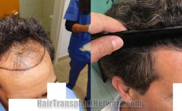 Hair transplantation surgery before and after images