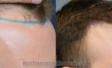 Hair transplantation surgery before and after images