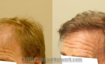 Hair transplantation surgery before and after images