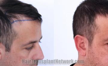 Hair transplantation surgery before and after images