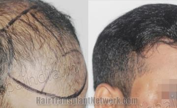 Hair transplantation surgery before and after images