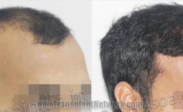 Hair transplantation surgery before and after images