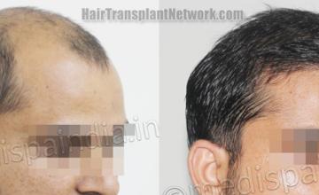 Hair transplantation surgery before and after images