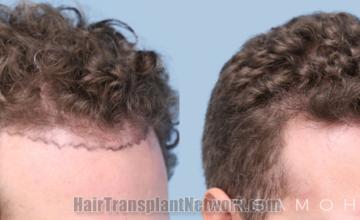 Hair transplantation surgery before and after images