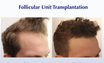 Hair transplantation procedure before and after results