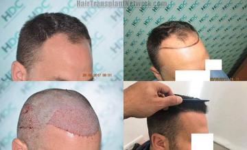 Hair restoration procedure after result images