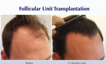 Hair transplantation procedure before and after results