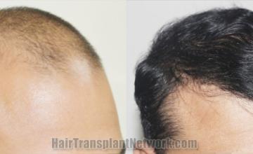 Hair transplantation surgery before and after images