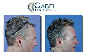 Hair restoration surgery before and after images