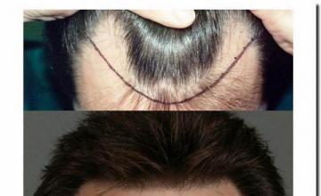 Hair restoration procedure results